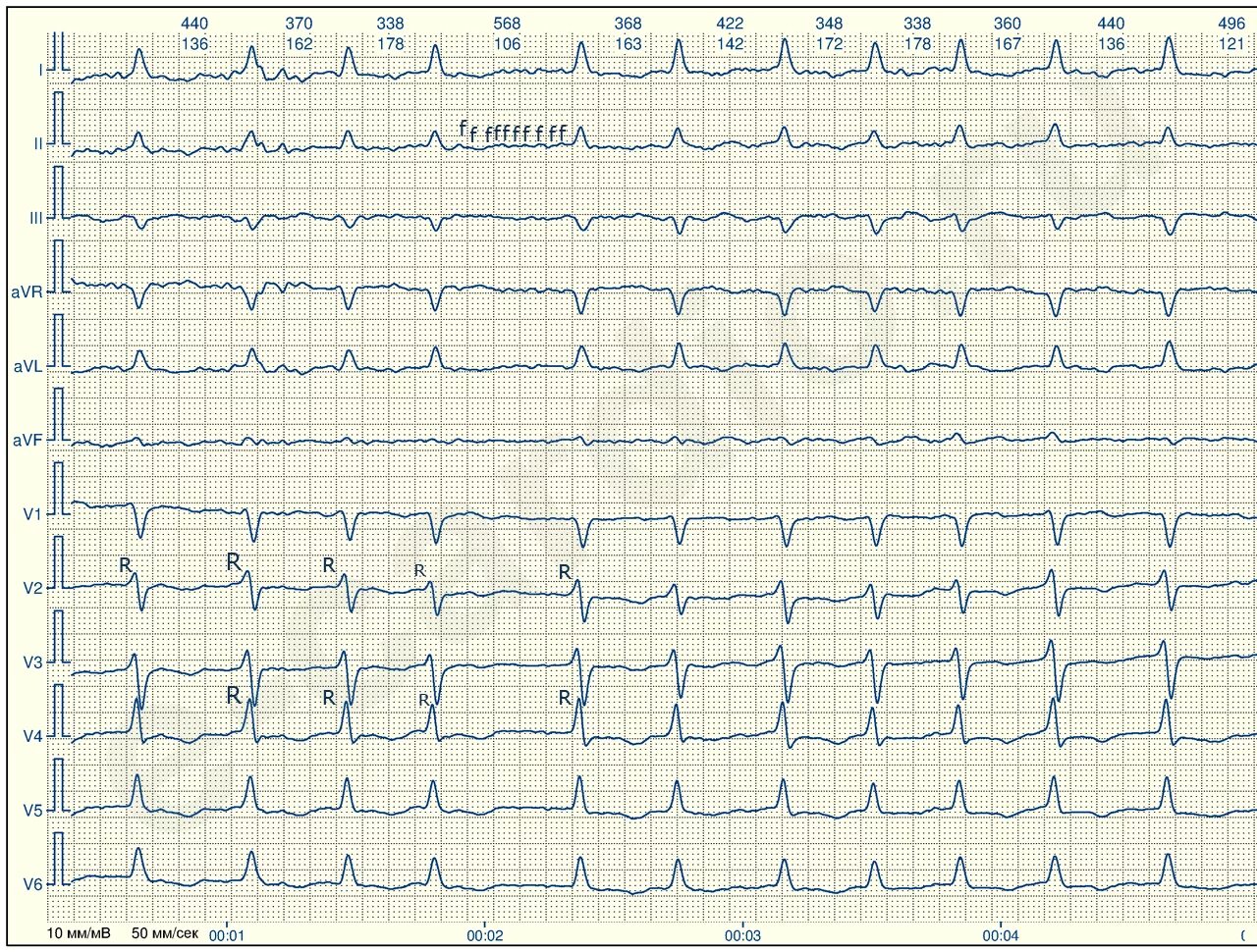Тахисистолия это. Фибрилляция предсердий на ЭКГ. Пленка ЭКГ аритмия пароксизмальная. Пароксизмальная форма фибрилляции предсердий ЭКГ. Формы фибрилляции предсердий ЭКГ.