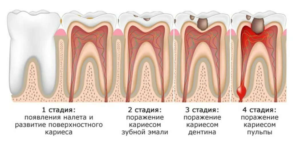 Как выглядит начальная стадия кариеса у детей Пришеечный кариес: стадии и методы лечения