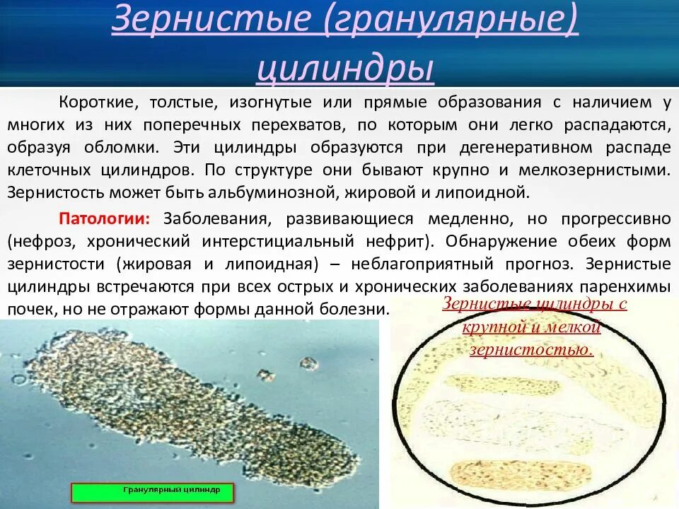 Почему в моче осадки. Гранулярные цилиндры. зернистые цилиндры. гранулярные цилиндры в моче. зернистые цилиндры в моче.