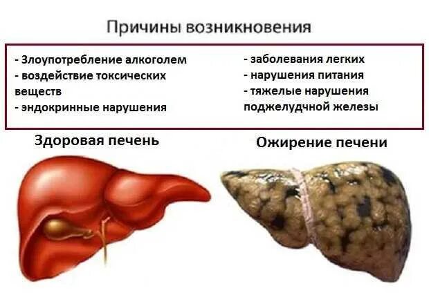 Какие фрукты можно при жировом гепатозе печени. Жировой гепатоз печени диета. диета при жировом гепатозе. диета для жирового гепатоза печени. диета при ожирении печени.