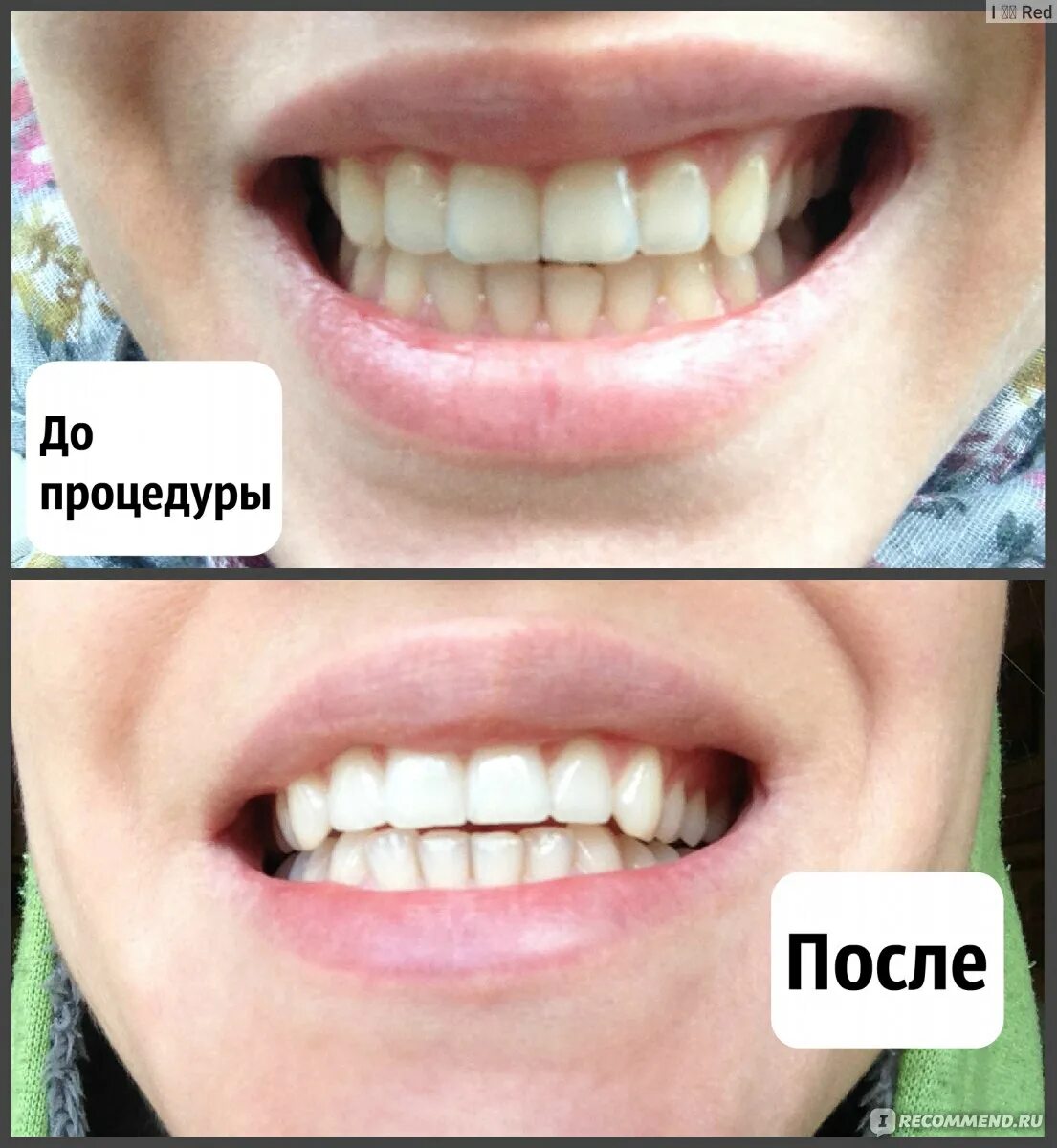 Профессиональная чистка зубов - "Два вида профессиональной чистки зубов - ультра