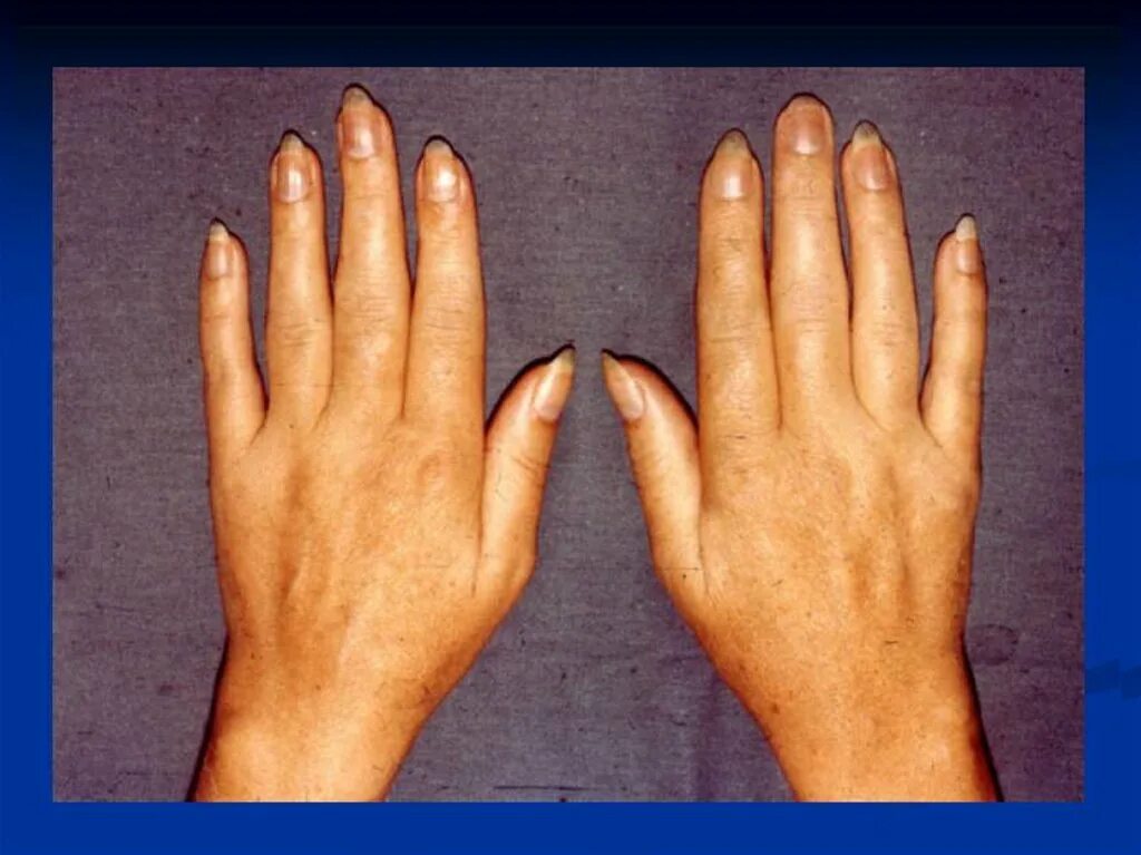 болезнь суставов рук. подагра ревматоидный артрит кистей. полиартроз межфаланговых суставов. ревматоидный полиартрит. ревматоидный полиартрит.