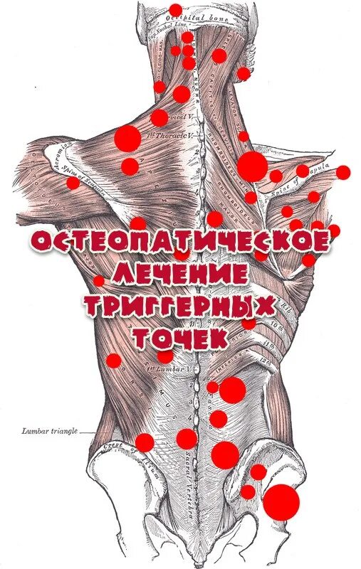 Триггерные точки это простыми словами. Миофасциальный синдром триггерные точки. Терапия триггерных точек. Карта триггерных точек человека. Карта триггерных точек на теле человека.