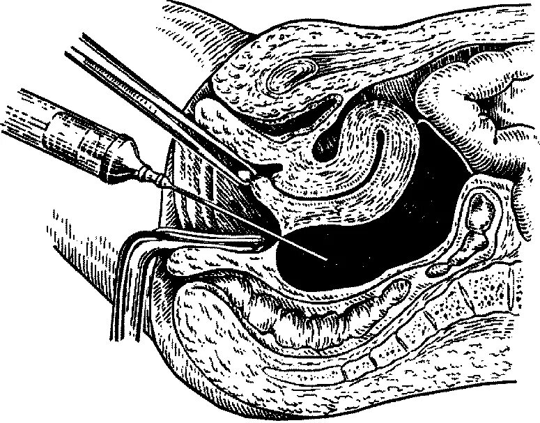 Накачали матку. Кульдоцентез (пункция заднего свода).. Внематочная беременность пункция заднего свода. Пункция заднего свода влагалища (кульдоцентез). Пункция прямокишечно-маточного углублени.