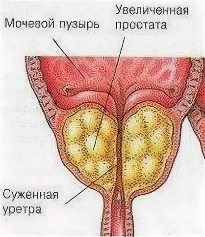 Фиброз предстательной железы