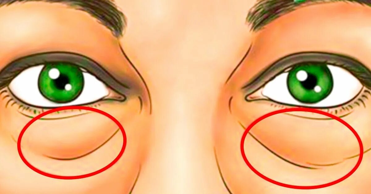 Песня мешки под глазами. Мешки под глазами. Отечные мешки под глазами. Мешки под глазами иллюстрация.