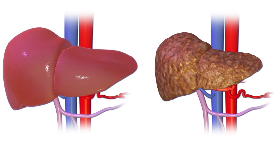 Клетки печени разрушаются. Нормальная печень и цирроз.