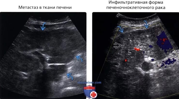 Вылечить метастазы в печени. Метастатическое поражение печени. УЗИ печени при метастазах. Усиление сосудистого рисунка печени на УЗИ.