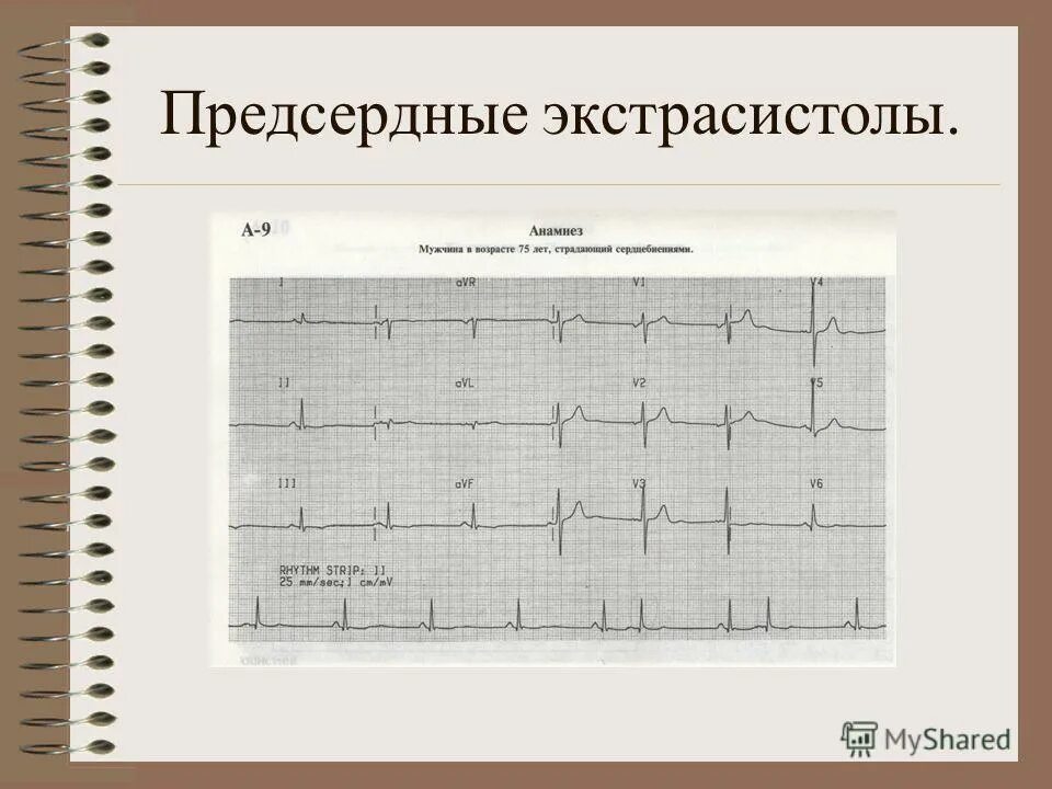 Синусовая брадикардия сердца у подростка. Синусовая брадикардия сердца у подростка