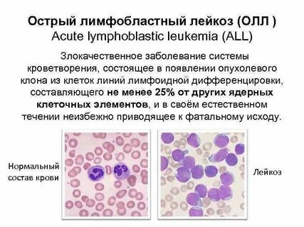 Лимфобластный лейкоз клинические рекомендации