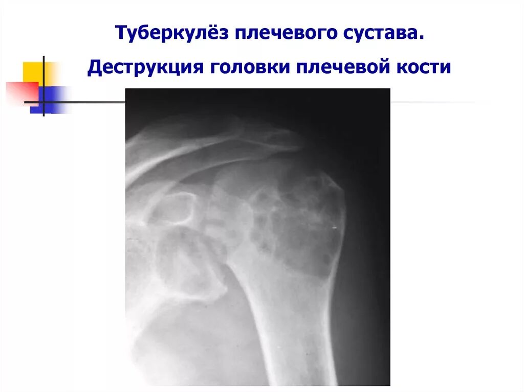 Туберкулез головки плечевой кости рентген. Туберкулез головки плечевой кости кт. Деструкция головки плечевой кости рентген. Туберкулез плечевого сустава рентгенограммы.