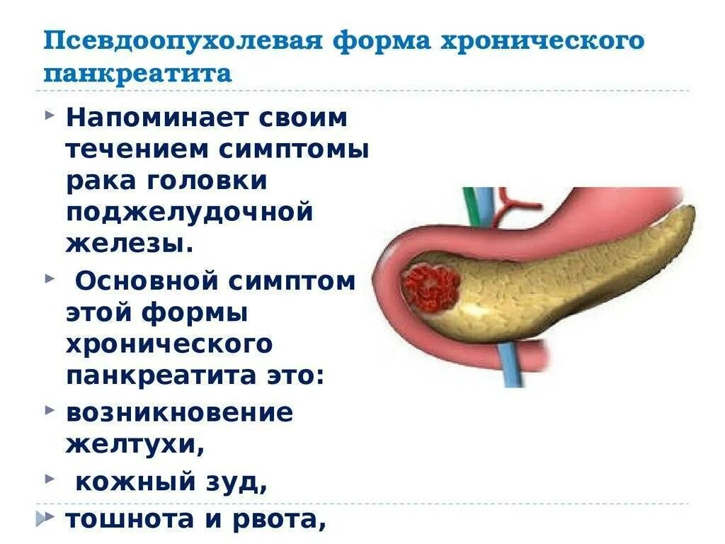 Хронический панкреатит поджелудочная железа. Острое воспаление поджелудочной. Хронические заболевания поджелудочной железы. Симптомы хронического панкреатита поджелудочной железы. 1 признаки поджелудочной