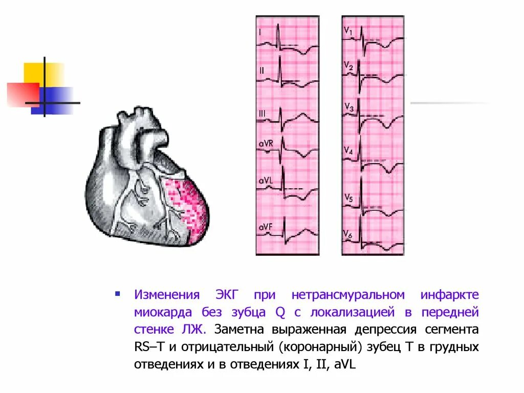 Изменение передней стенки левого желудочка. Изменения миокарда левого желудочка на ЭКГ. Дистрофические изменения в миокарде лж на ЭКГ. Диффузно дистрофические изменения миокарда левого желудочка ЭКГ. Умеренные изменения миокарда левого желудочка.