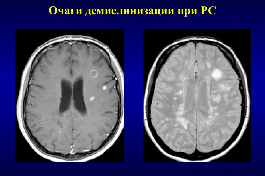 Демиелинизация на мрт рассеянный склероз. Демиелинизация головного мозга мрт. Очаги демиелинизации спинной мозг мрт. Очаги рассеянного склероза на мрт.