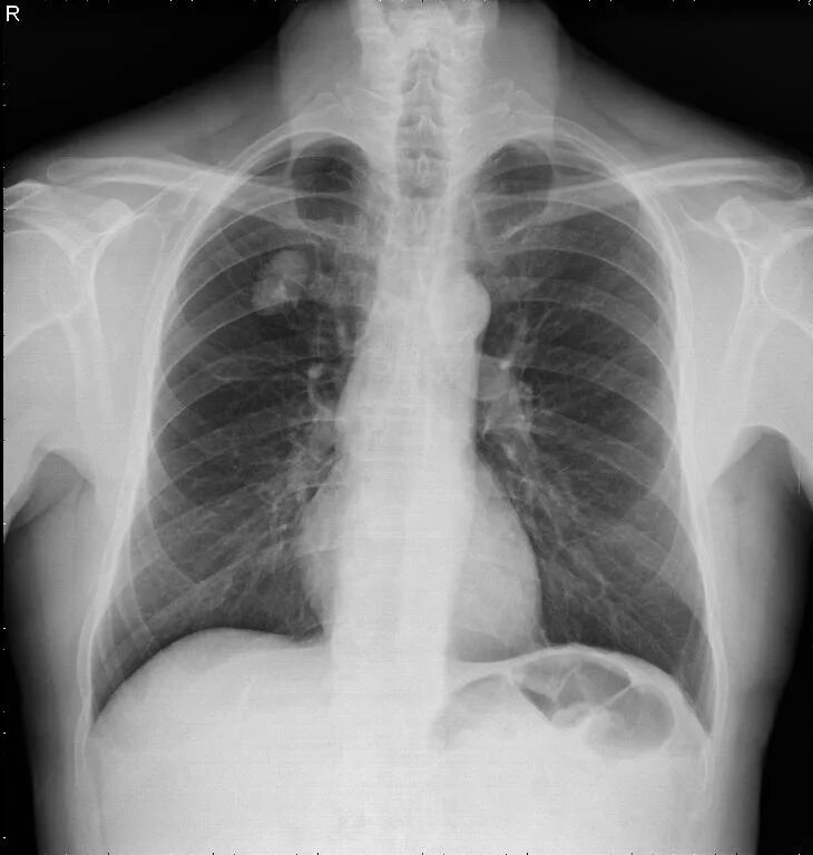 Tarceva: Nice refuses to approve lung cancer drug to NHS