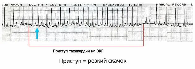 Резко сильное сердцебиение. Тахикардия пульс. Тахикардия в спокойном состоянии. Внезапная тахикардия в состоянии покоя причины. Высокое сердцебиение.