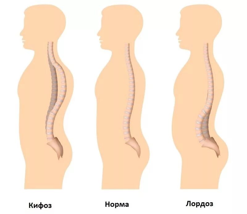 Усиленный лордоз. Искривление позвоночника лордоз. Гиперлордоз и кифоз грудного отдела позвоночника. Лордоз поясничного отдела позвоночника норма. Искривление позвоночника гиперлордоз.