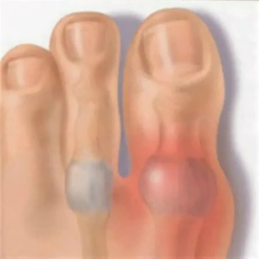 Pin on Truth About Gout