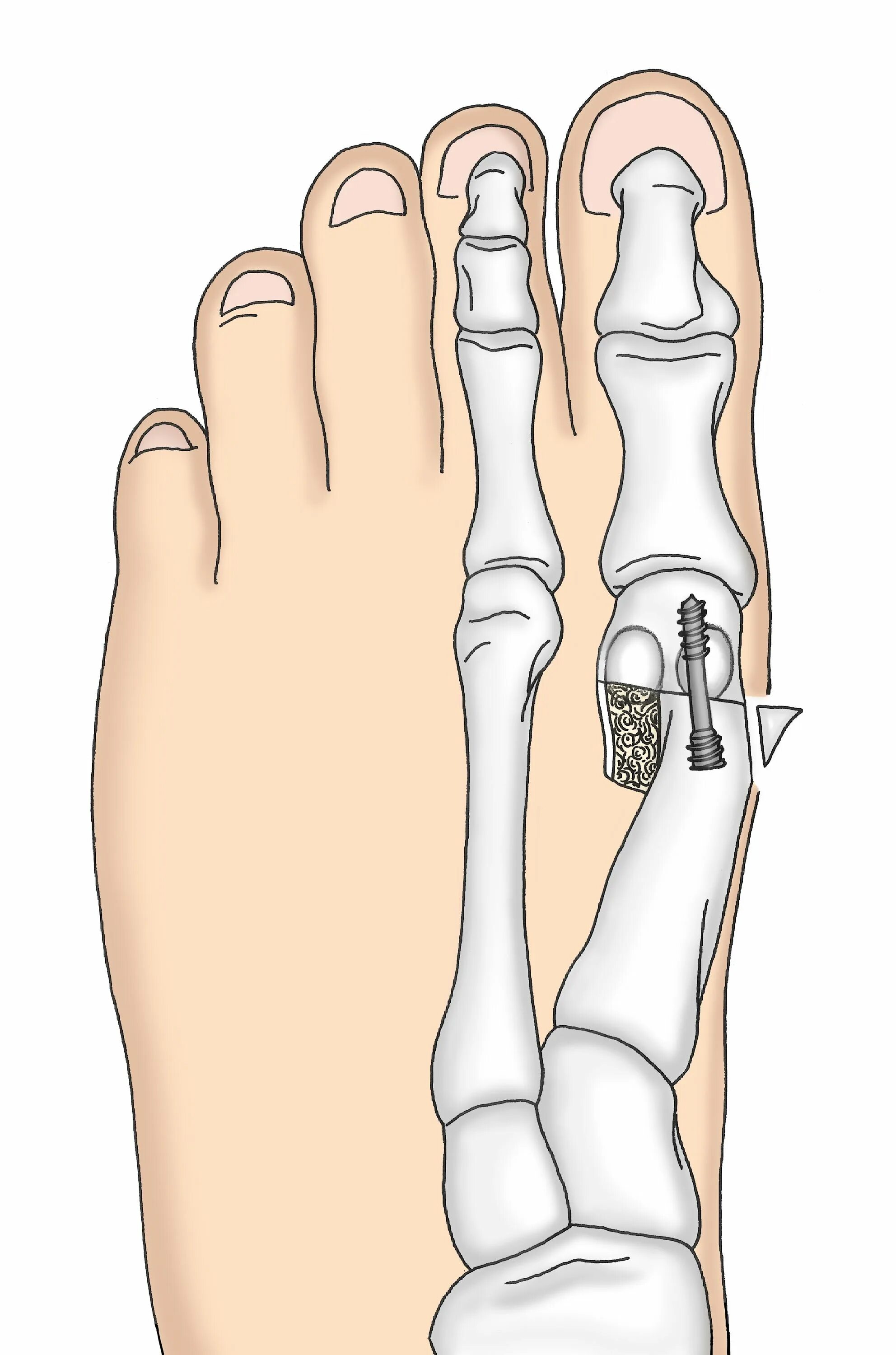 Халлюкс вальгус. Халлюкс вальгус степени. Hallux valgus что это