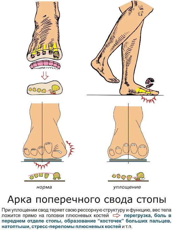 Продольный и поперечный свод стопы. Болит стопа в районе плюсневых костей. Болит стопа сбоку с внутренней стороны. Наружный продольный свод стопы. Болят своды стоп лечение.