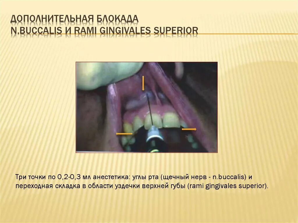 Переходная складка слизистой. Переходная складка стоматология. Переходная складка строение.