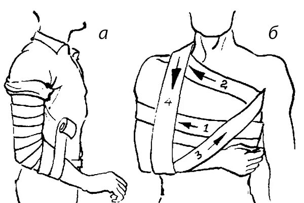 Повязки при ранении конечностей. Наложение повязки при ранении конечностей. Повязки при ранении конечностей. Повязки при ранении конечностей. Наложение мягких бинтовых повязок.