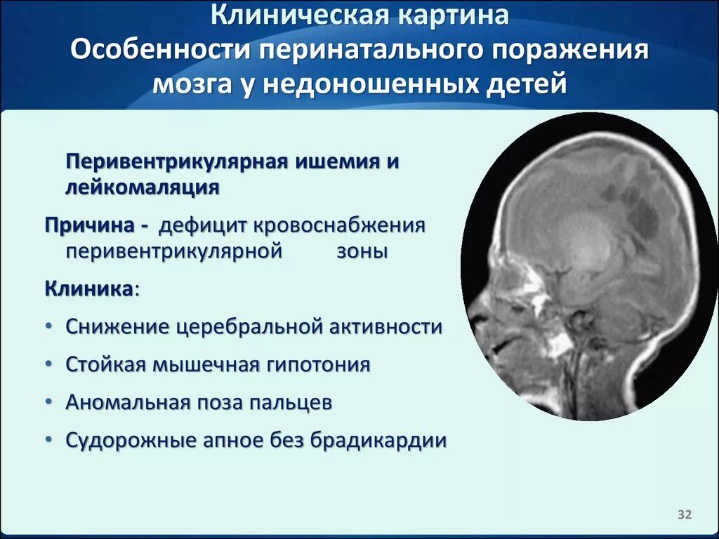 Резидуальное поражение головного. Поражение головного мозга. Перивентрикулярная энцефалопатия. Аноксическое поражение головного мозга это. Поражение головного мозга у детей.