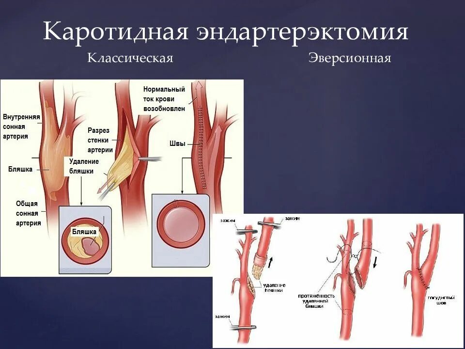 Эндартерэктомия сонной операция. Эндартерэктомия по ДЕБЕКИ. Атеросклероз сонных артерий эндартерэктомия. Эверсионная эндартерэктомия. Эверсионная каротидная эндартерэктомия