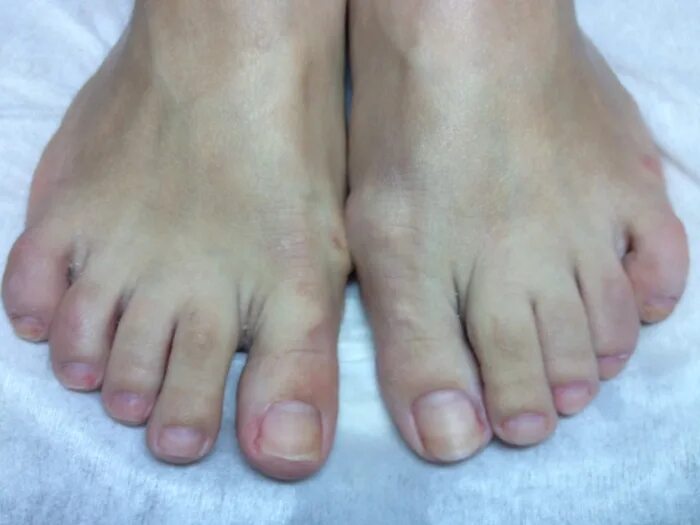 фото ноги без пальца