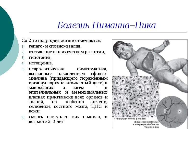 Болезнь ниманна пика тип а. Болезнь ниманна пика проявления.