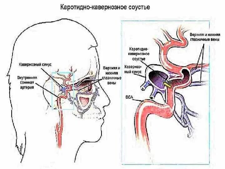 Аневризма сонной артерии что это. Кавернозно каротидное соустье. Аневризма кавернозного синуса мрт. Синус тромбоз кавернозного синуса. Тромбоз кавернозного синуса оториноларингология.