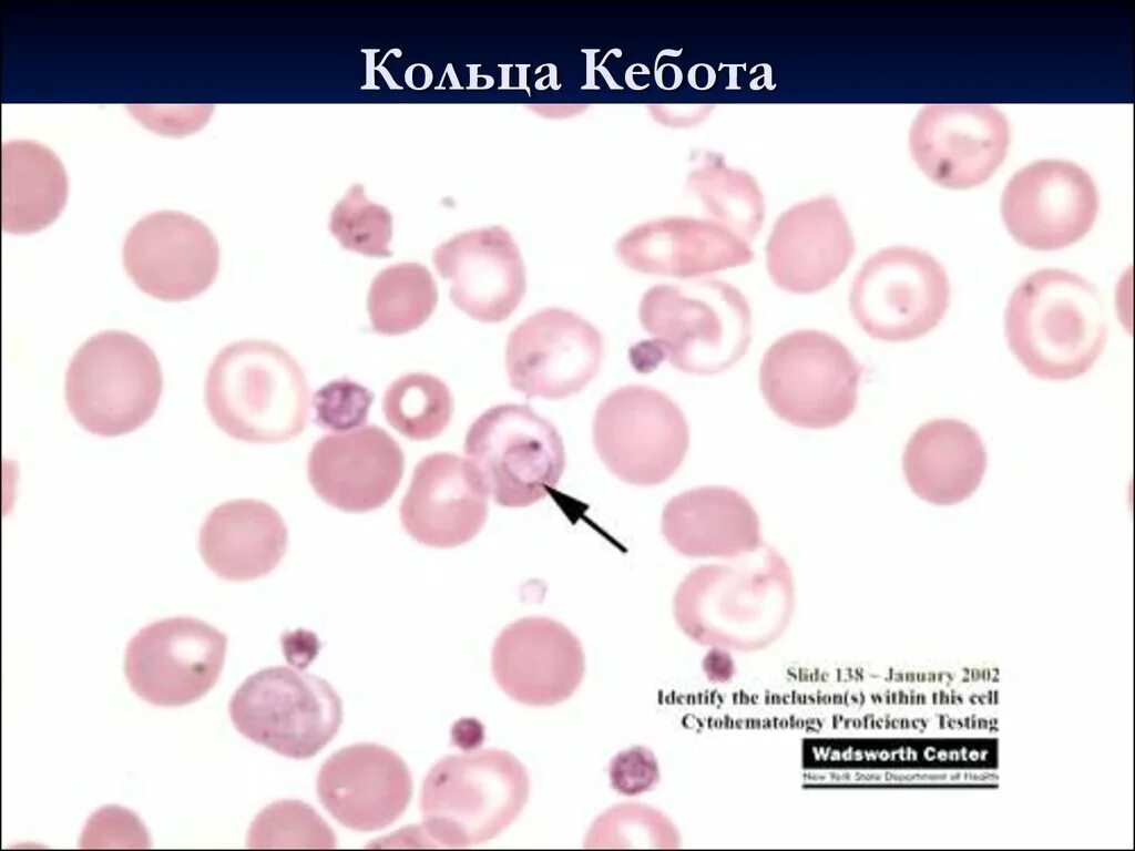 Тельца гейнца. Тельца Жолли кольца Кебота анемия в12. Тельца Жолли и кольца Кебота. Кольца Кебота микроскопия. В эритроцитах кольца Кебота тельца Жолли.