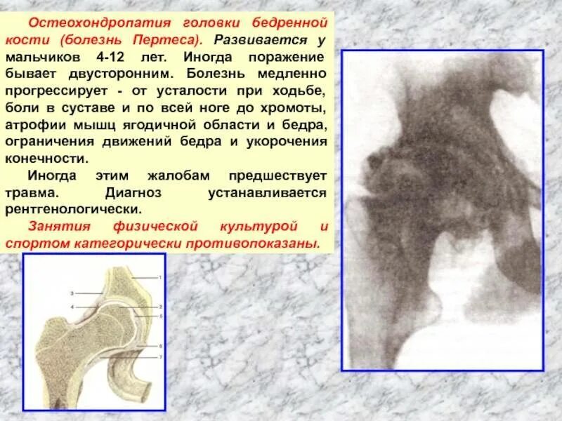 Какие бывают заболевания костей
