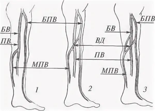 БПВ нижних конечностей норма. Несостоятельность клапанов БПВ нижних конечностей. Тромбоз бпв