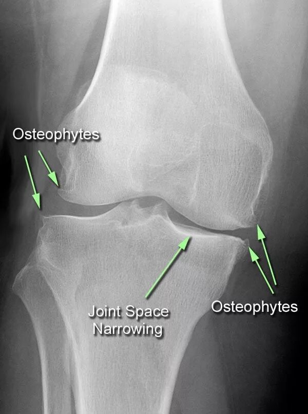 Остеофиты что это такое и как лечить. Остеоартроз рентген остеофиты. Гонартроз остеофиты рентген. Остеофиты коленного сустава рентген. Хондропатия коленного сустава рентген.