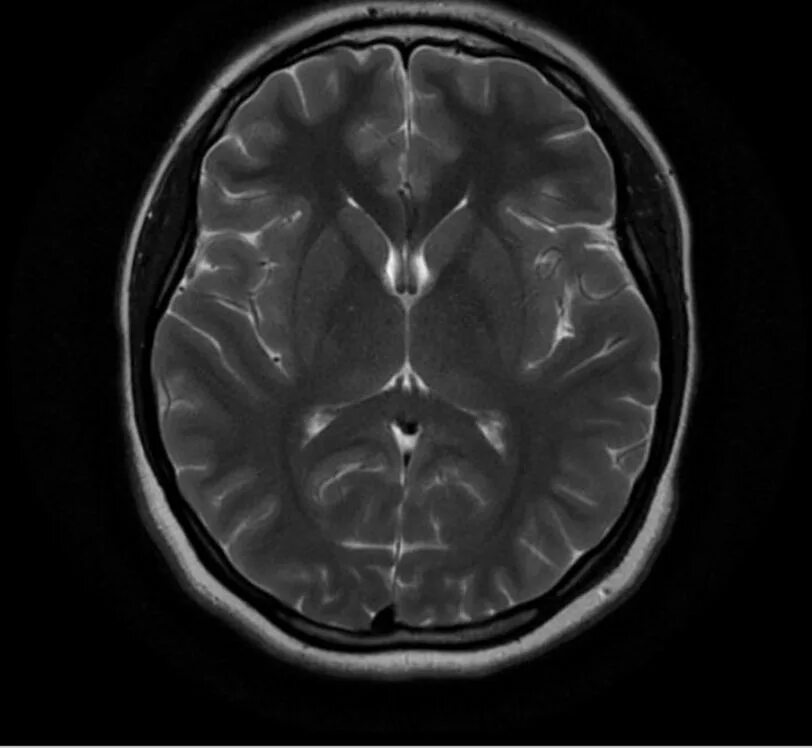 Кт томограмма головного мозга. Кт головного мозга норма. MRI головного мозга. Магнитно резонансные томограммы головного мозга.