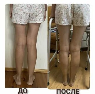 Ноги х в 2 года