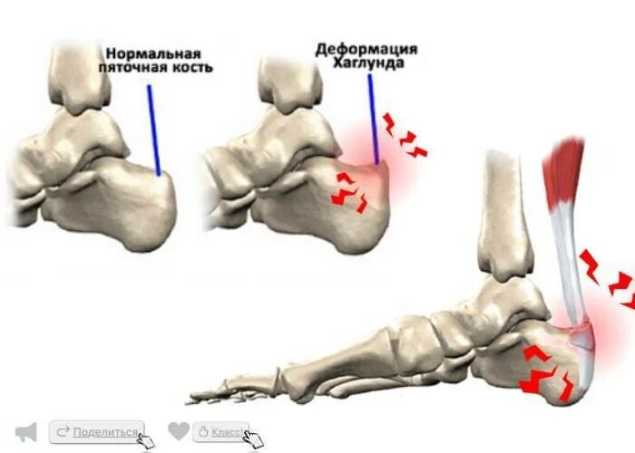подошвенный (плантарный) фасциит. ахиллово сухожилие шишка. бурсит плантарной фасции стопы. больно пяточную кость. больно пяточную кость.