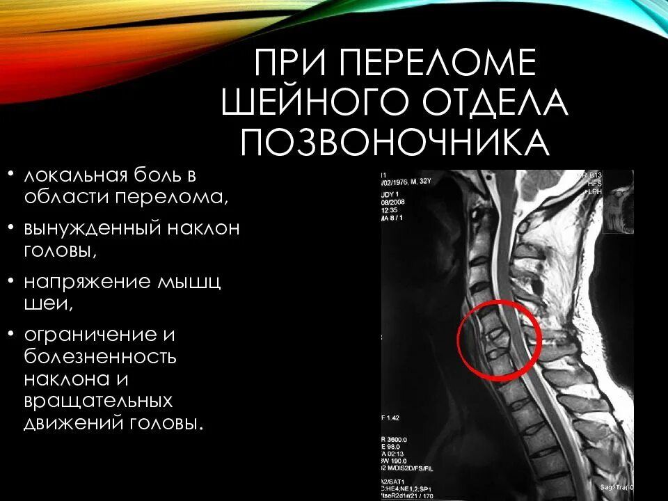 Компрессионный перелом позвоночника 4-5 позвонок. Компрессионный перелом шейного отдела позвоночника: симптомы. Компрессионный перелом шейного отдела симптомы. Компрессионный перелом с5.