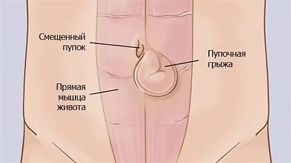 Как можно определить грыжу. Как можно определить грыжу