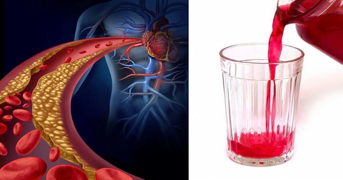 Очистить кровеносные сосуды. Как очистить сосуды от холестериновых тромбов