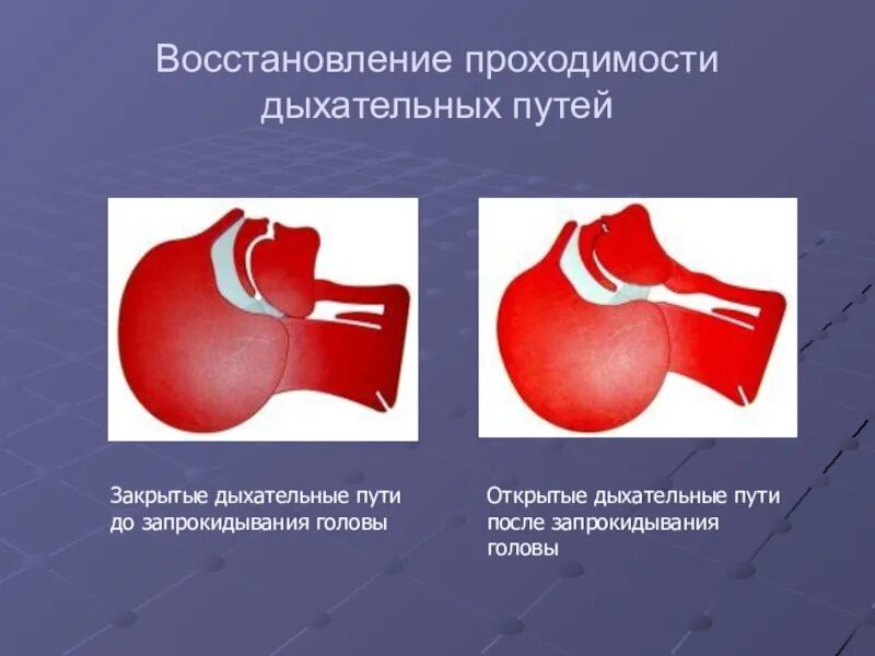 Восстановление проходимости дыхательных путей. СЛР обеспечение проходимости дыхательных путей. Восстановление проходимости дых путей. Восстановление проходимости дыхательных путей при СЛР.