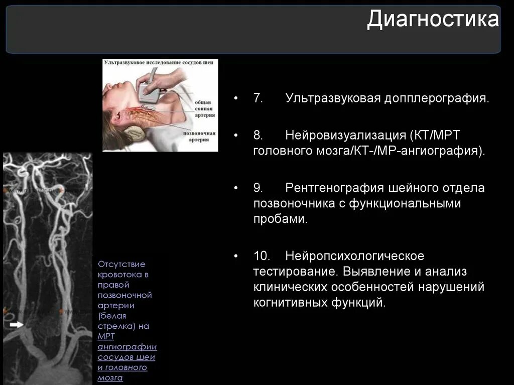 Вертебрально базилярная недостаточность. Синдром вертебробазилярной недостаточности. Синдром вертебробазилярной артерии. Синдром вертебробазилярной артериальной системы что это такое. Кт и мрт Нейровизуализация.