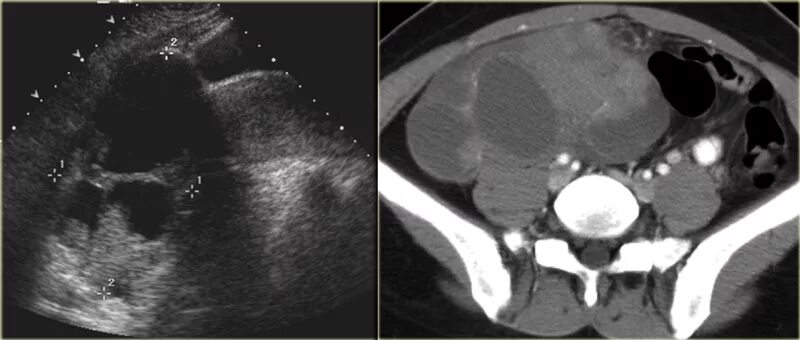 Эндометриоидная киста кт. Эндометриоидная киста яичника кт. Можно ли спутать кисту