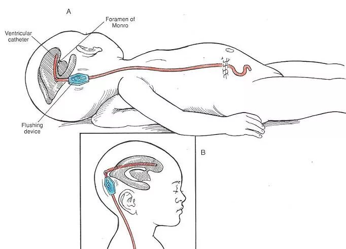 Шунт при гидроцефалии схема. Шунт головного мозга при гидроцефалии. Шунтирование головы для вывода лишнего ликвора. Как выглядит шунт