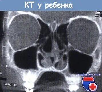 Опухоль носовых пазух