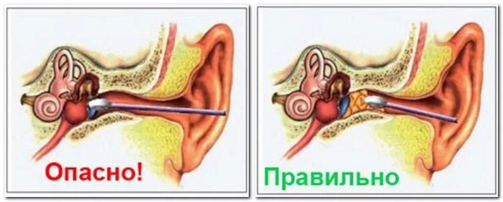 Отит как правильно. Воспалённая барабанная перепонка. Буллёзный отит барабанная перепонка. Буллёзный отит барабанная перепонка. Мезотимпанит барабанная перепонка.