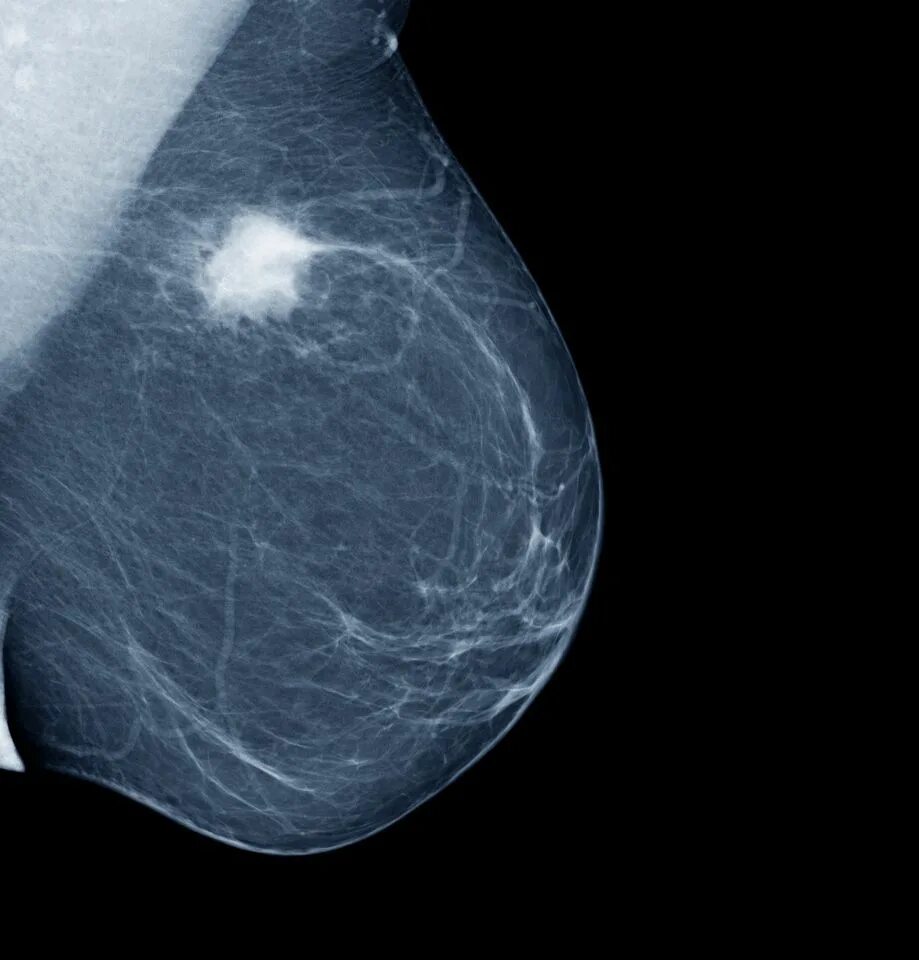 Маммография рак молочных желез