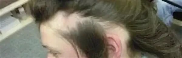 андрогенная алопеция у женщин. причины сильного выпадения волос. гормон роста волос. гормон роста волос у женщин. из за какого гормона выпадают волосы.