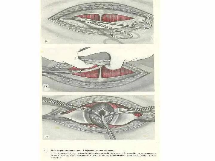 Кесарево сечение топографическая анатомия. Корпоральное кесарево сечение. Корпоральный шов на матке. Корпоральное кесарево сечение показано:. Техника кесарева сечения